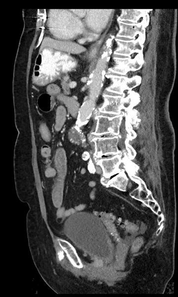 File:Closed loop small bowel obstruction - adhesions (Radiopaedia 59269-66611 C 52).jpg