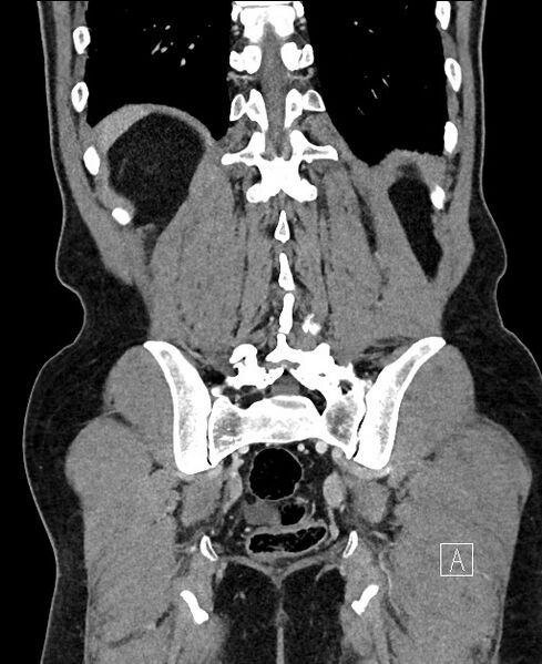 File:Closed loop small bowel obstruction - internal hernia (Radiopaedia 57806-64778 A 96).jpg