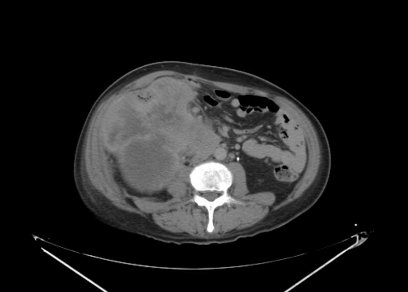 File:Colon cancer mimicking renal cell carcinoma (Radiopaedia 28986-29335 Axial C+ delayed 41).jpg