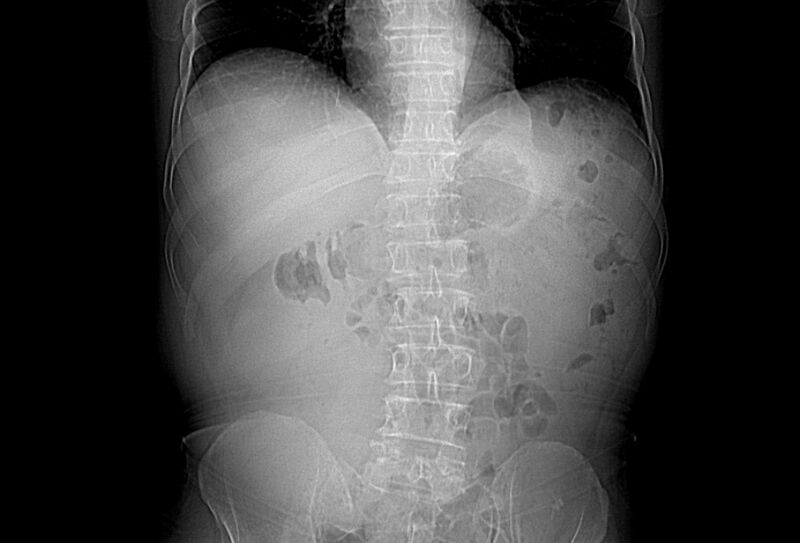 File:Colon cancer mimicking renal cell carcinoma (Radiopaedia 28986-29335 CT scout 1).jpg