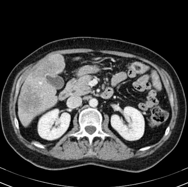 File:Colon carcinoma with hepatic metastases (Radiopaedia 29477-29961 A 43).jpg