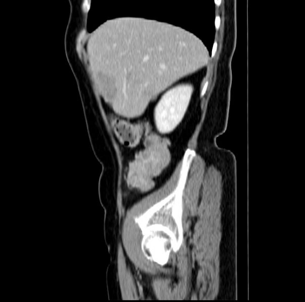 File:Colon carcinoma with hepatic metastases (Radiopaedia 29477-29961 C 12).jpg
