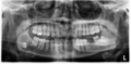 Dentigerous cyst (Radiopaedia 43924).png