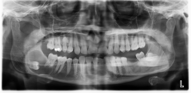 File:Dentigerous cyst (Radiopaedia 43924).png