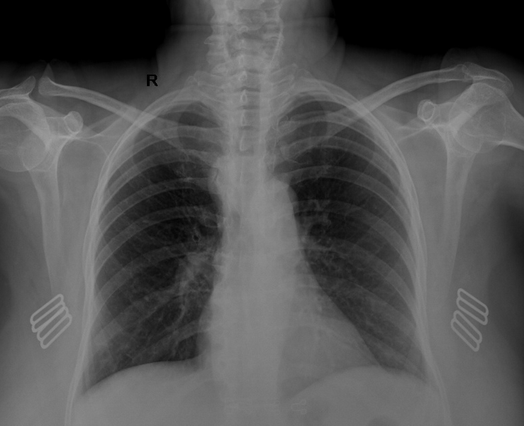 File:Double aortic arch (Radiopaedia 69148).png