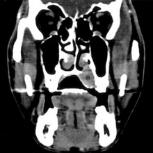 CT scan face- extraskeletal Ewing sarcoma hard palate