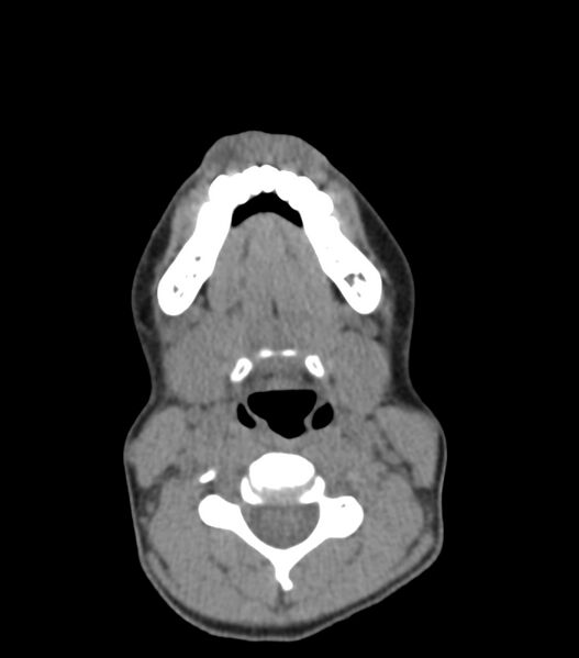 File:Nasoorbitoethmoid fracture (Radiopaedia 90044-107205 Axial non-contrast 49).jpg