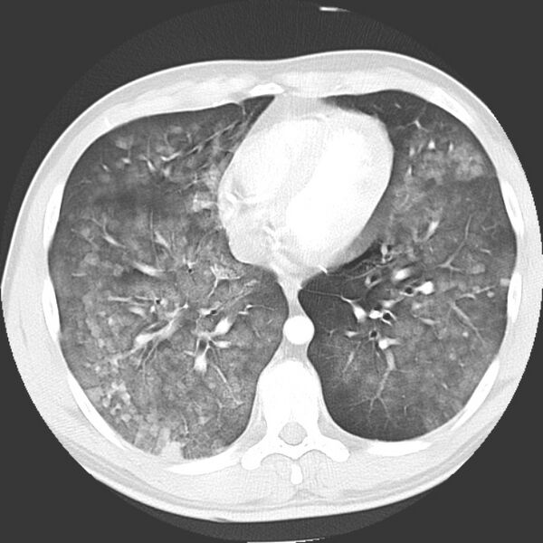 File:Near drowning pulmonary edema (Radiopaedia 16868-16591 Axial lung window 34).jpg