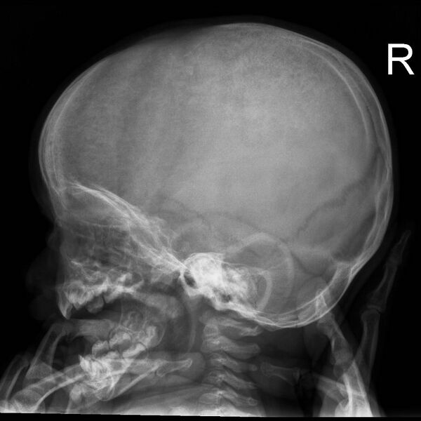 File:Neuroblastoma with skull metastases (Radiopaedia 30326-30957 Lateral 1).jpg
