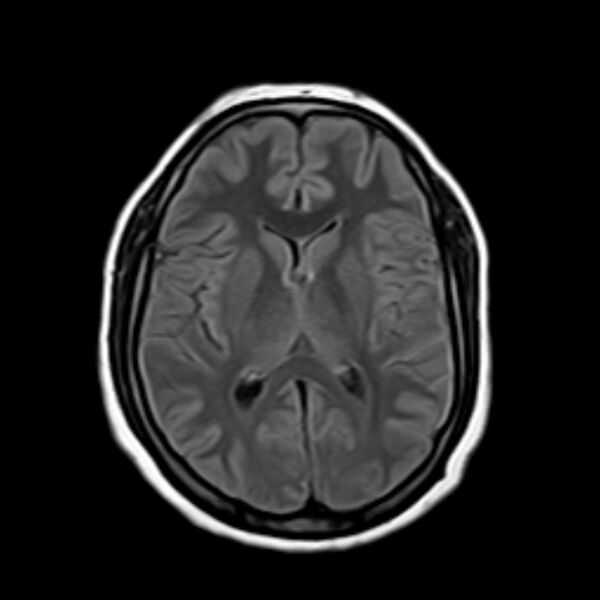 File:Neurofibromatosis type 2 (Radiopaedia 67470-76871 Axial FLAIR 13).jpg