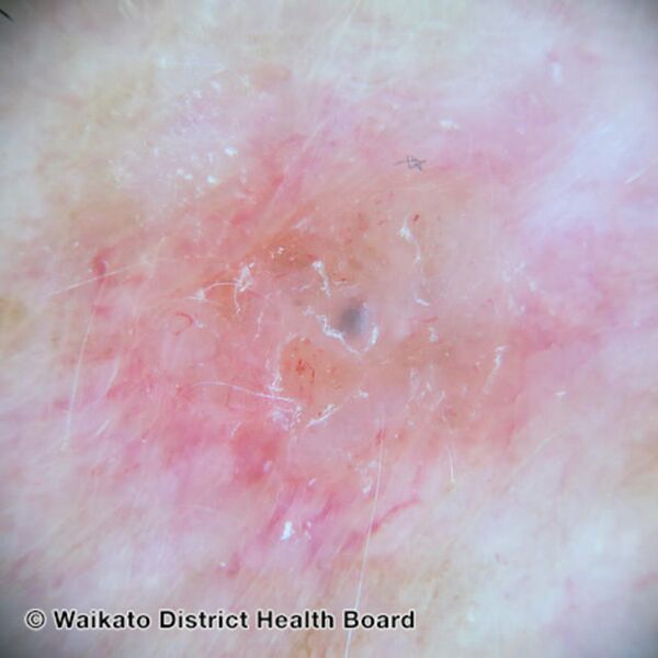File:Nodular basal cell carcinoma dermoscopy (DermNet NZ nbcc-wdhb).jpg