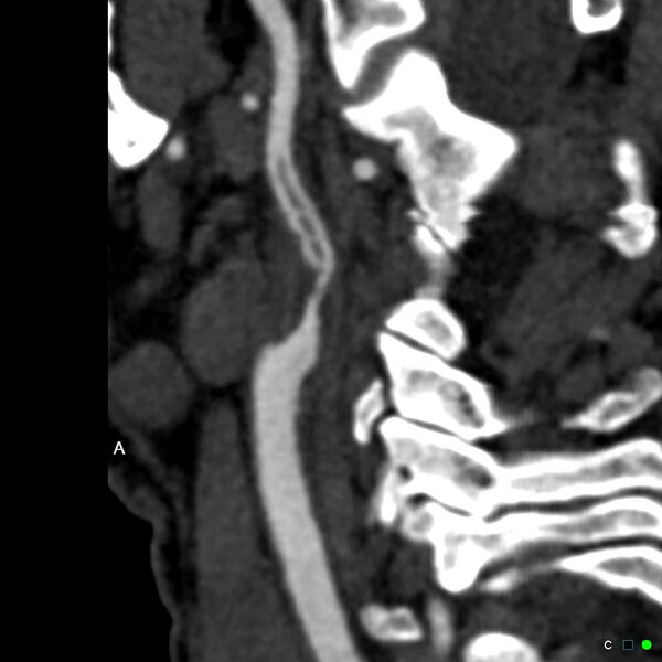 File:Non-occlusive intraluminal internal carotid artery thrombus (Radiopaedia 37751-39658 A 62).jpg