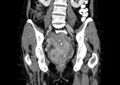 Non-puerperal uterine inversion (Radiopaedia 78343-91094 B 23).jpg