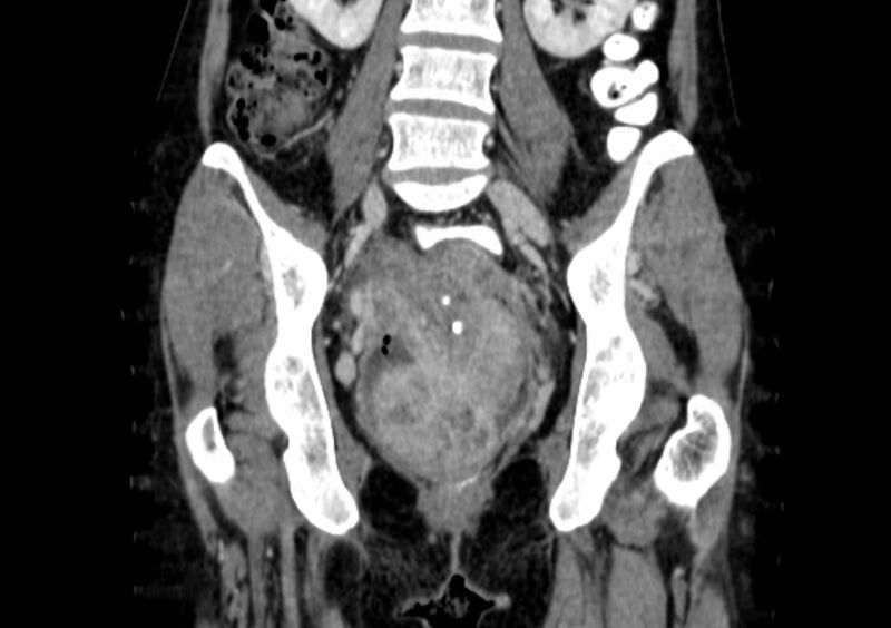 File:Non-puerperal uterine inversion (Radiopaedia 78343-91094 B 23).jpg