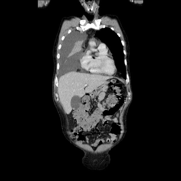 File:Non small-cell lung cancer (Radiopaedia 24467-24769 Coronal C+ delayed 16).jpg