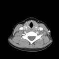 Normal CT of the neck (Radiopaedia 14575-14500 Axial C+ 46).jpg