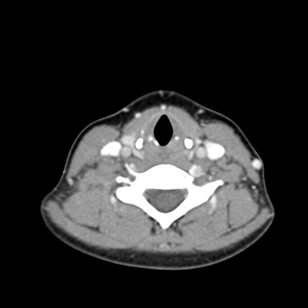 File:Normal CT of the neck (Radiopaedia 14575-14500 Axial C+ 46).jpg