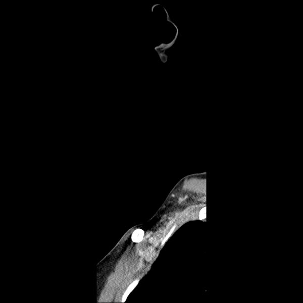 File:Normal CT of the neck (Radiopaedia 14575-14500 Sagittal C+ 2).jpg