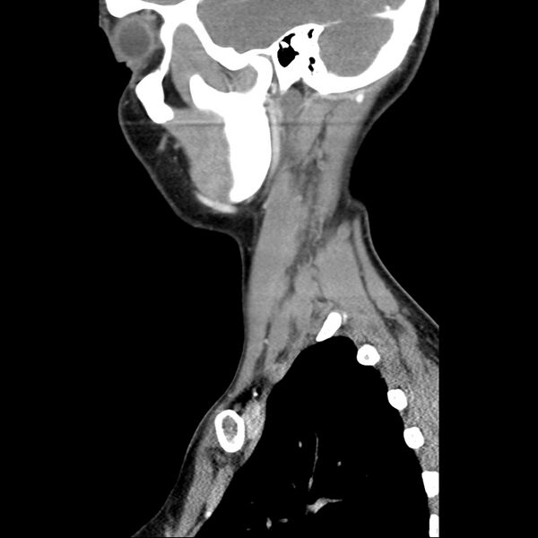 File:Normal CT of the neck (Radiopaedia 14575-14500 Sagittal C+ 41).jpg
