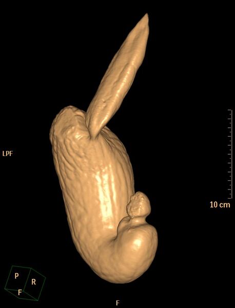 File:Normal CT virtual gastroscopy (Radiopaedia 29960-30501 3D VG 17).jpg