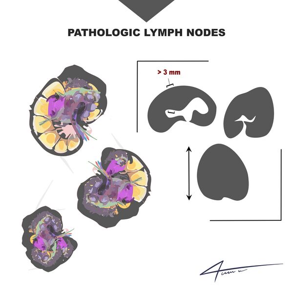 File:Normal and pathological axillary lymph nodes (Radiopaedia 84164-99438 B 1).jpeg