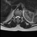 Normal cervical and thoracic spine MRI (Radiopaedia 35630-37156 H 6).png