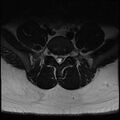 Normal lumbar spine MRI (Radiopaedia 47857-52609 Axial T2 25).jpg