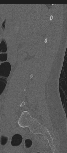 File:Normal lumbosacral CT (Radiopaedia 37923-39867 Sagittal bone window 73).png