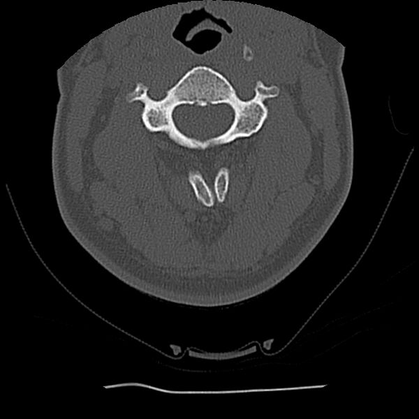 File:Normal trauma spine imaging (Radiopaedia 31753-32686 Axial bone window 29).jpg