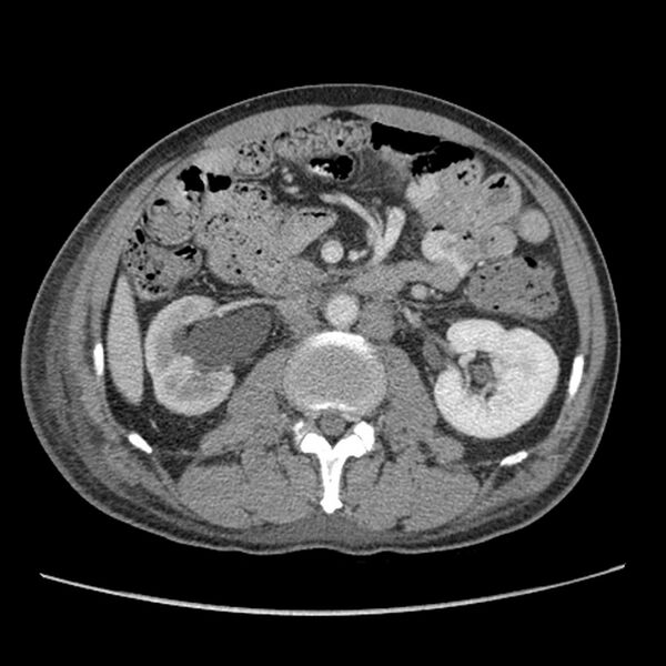 File:Obstructive bladder transitional cell carcinoma (Radiopaedia 9825-10410 A 11).jpg