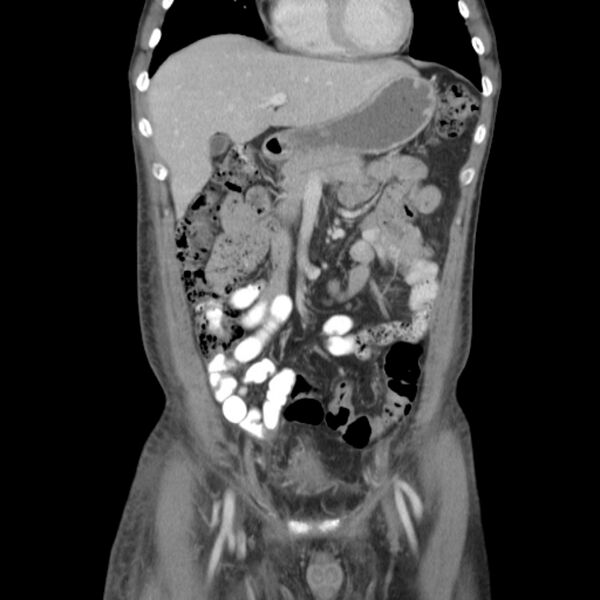 File:Obstructive bladder transitional cell carcinoma (Radiopaedia 9825-10410 B 3).jpg