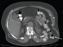 CT scan-Grynfeltt-Lesshaft hernia.