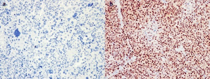a)Adrenocortical carcinoma has positive staining for SF-1 b) sarcomatoid region of adrenocortical carcinoma absent staining SF-1.