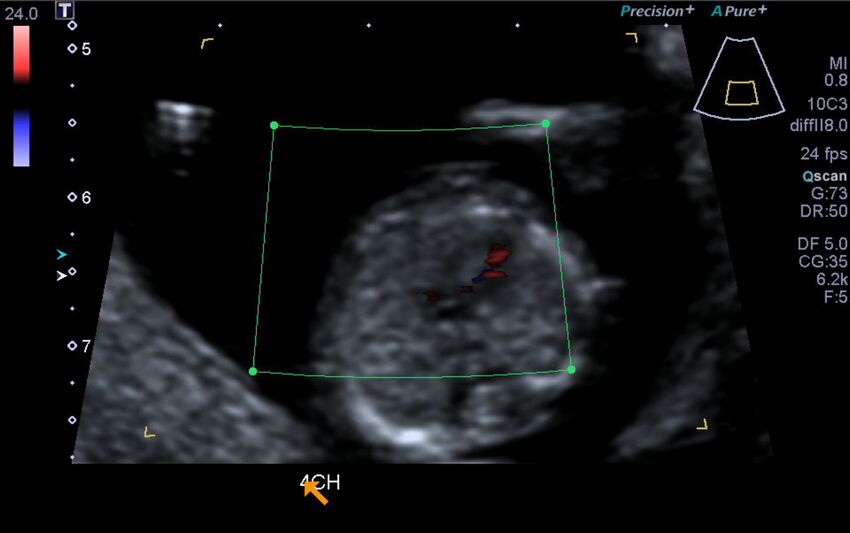 1st trimester nuchal-morphology ultrasound (Radiopaedia 44706-48477 Heart views cine with colour 74).jpg