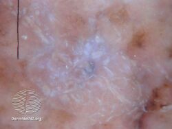 A nodular melanoma arising within a superficial spreading melanoma