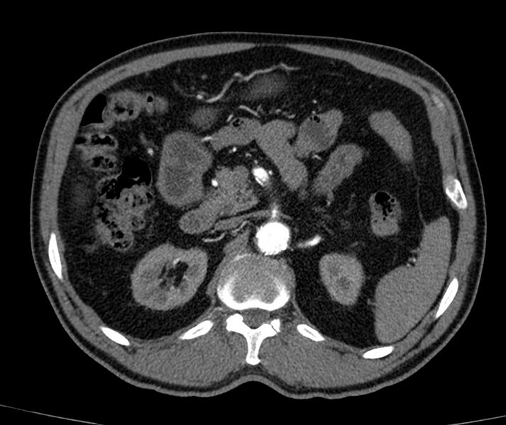 File:Abdominal aortic aneurysm (Radiopaedia 22421-22458 C+ arterial phase 23).jpg