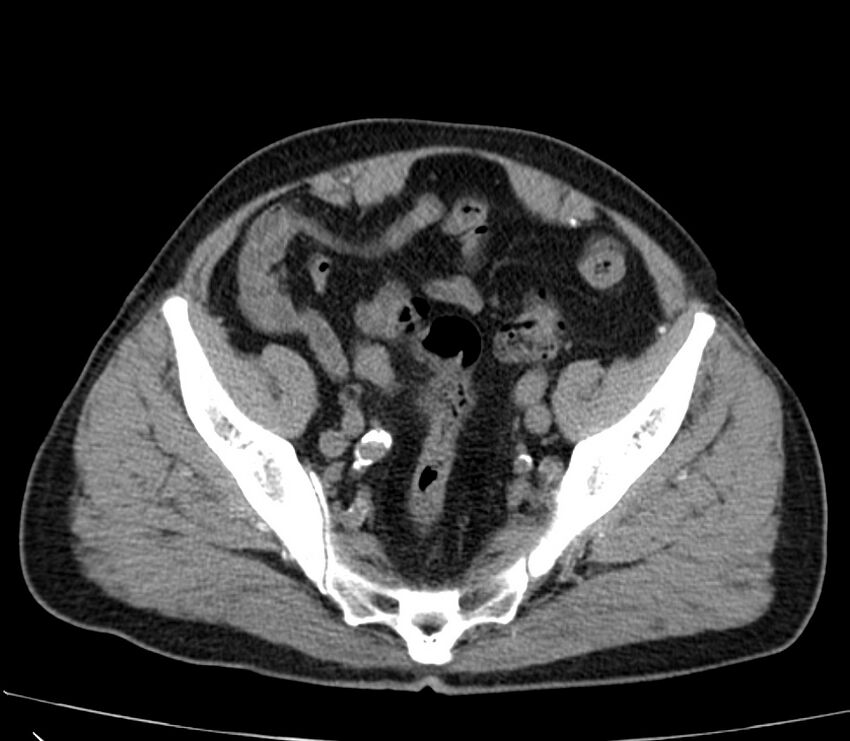 Abdominal aortic aneurysm (Radiopaedia 22421-22458 non-contrast 46).jpg