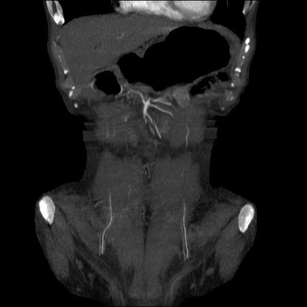 File:Abdominal aortic aneurysm (Radiopaedia 23703-23856 Coronal C+ arterial phase 1).jpg
