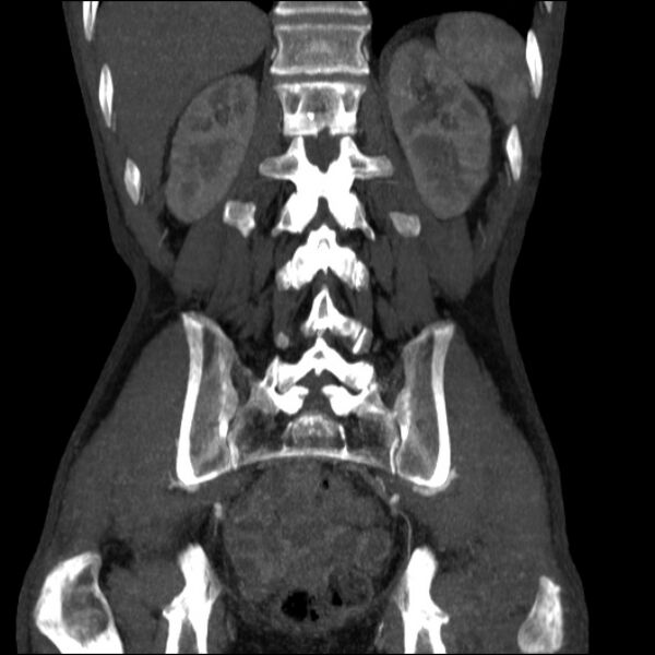 File:Abdominal aortic aneurysm (Radiopaedia 23703-23856 Coronal C+ arterial phase 27).jpg