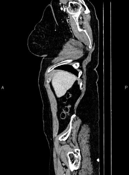 File:Abdominal aortic aneurysm (Radiopaedia 85063-100606 Sagittal C+ arterial phase 5).jpg