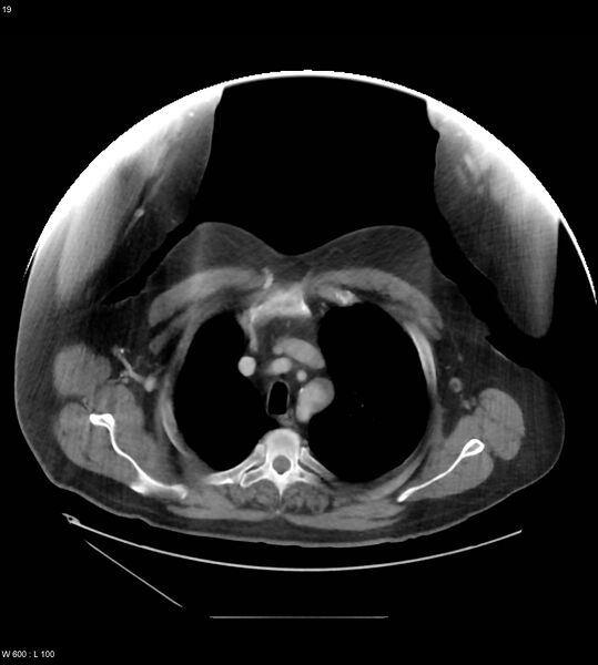 File:Abdominal aortic aneurysm with intramural hematoma then rupture (Radiopaedia 50278-55631 Axial C+ arterial phase 10).jpg