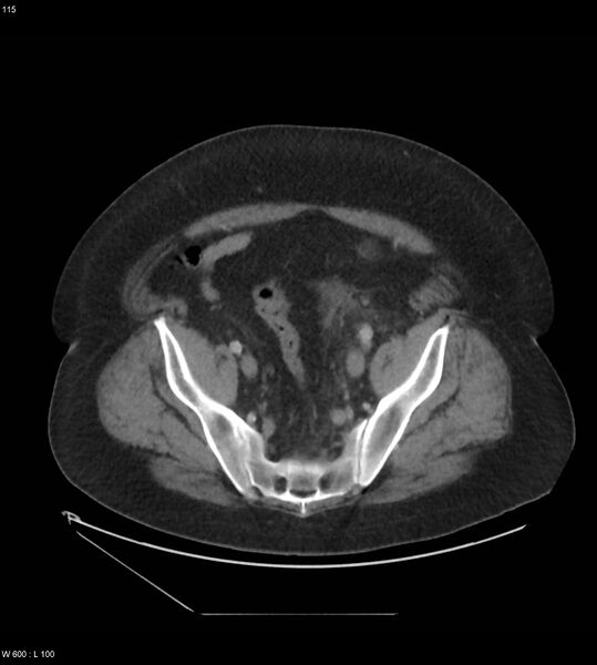 File:Abdominal aortic aneurysm with intramural hematoma then rupture (Radiopaedia 50278-55631 Axial C+ arterial phase 106).jpg