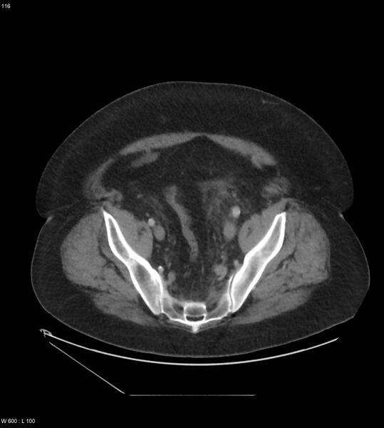 File:Abdominal aortic aneurysm with intramural hematoma then rupture (Radiopaedia 50278-55631 Axial C+ arterial phase 107).jpg
