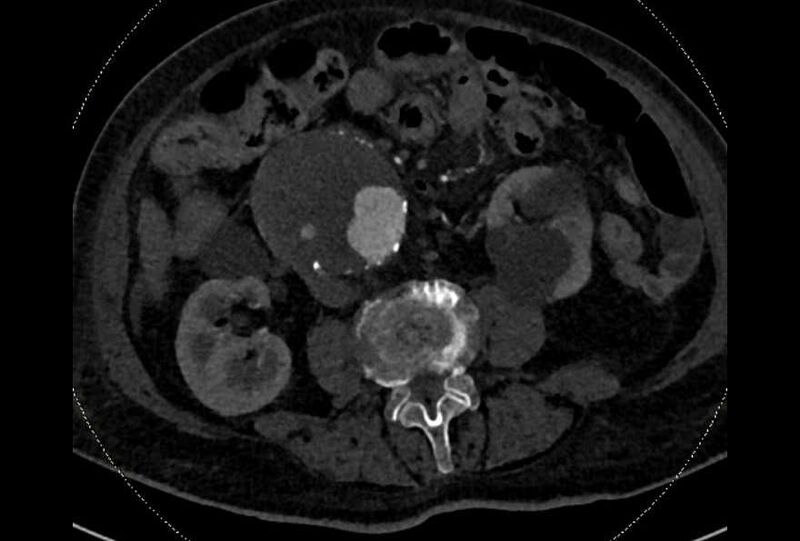File:Abdominal aortic aneurysm with thrombus fissuration (Radiopaedia 73192-83919 Axial C+ arterial phase 106).jpg
