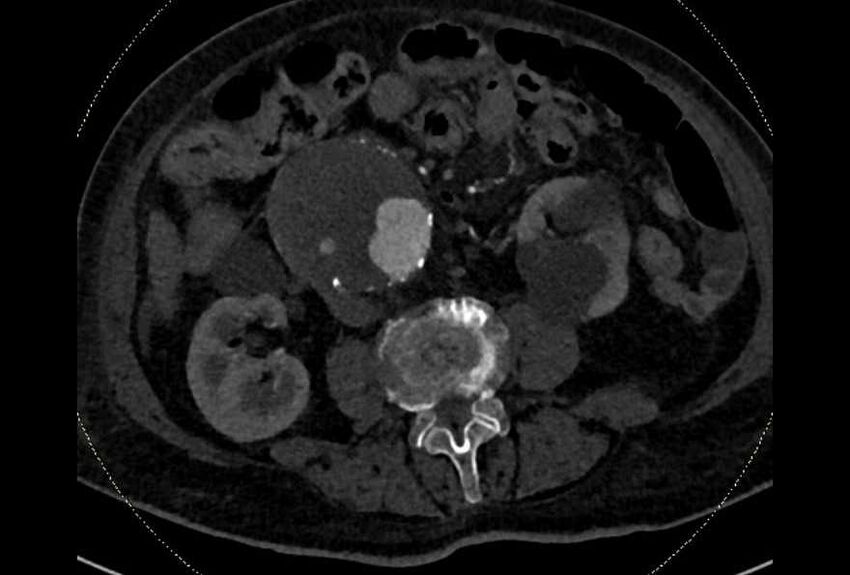 Abdominal aortic aneurysm with thrombus fissuration (Radiopaedia 73192-83919 Axial C+ arterial phase 106).jpg