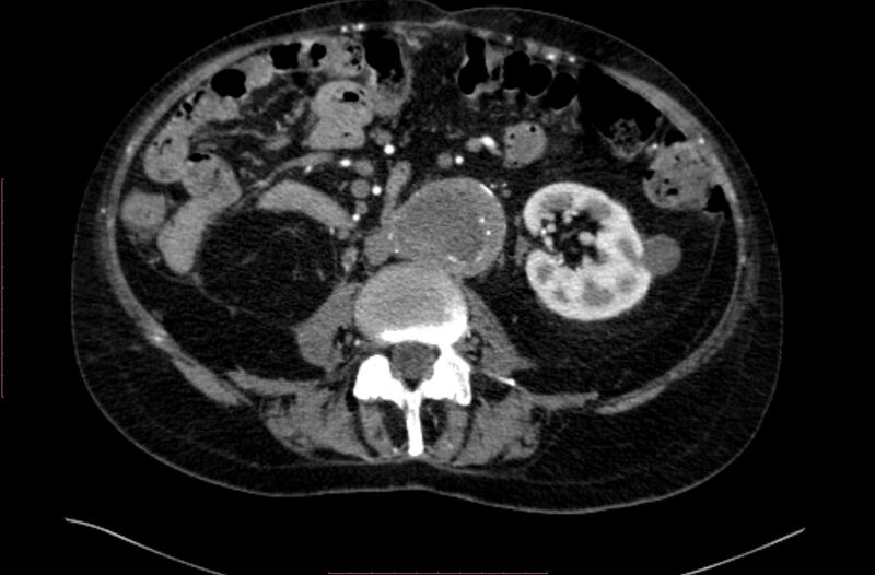 File:Abdominal aortic interposition tube graft and aneurysm thrombosis (Radiopaedia 71438-81857 Axial C+ arterial phase 86).jpg