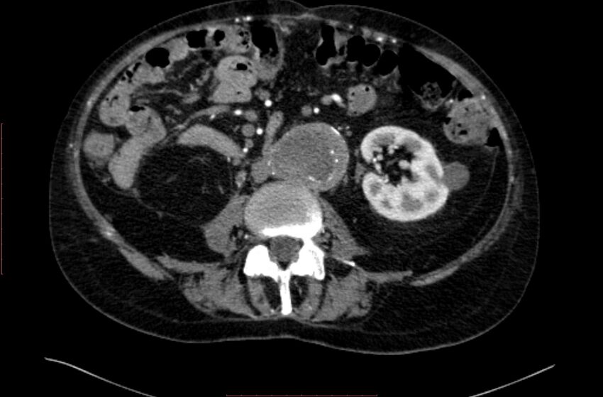 Abdominal aortic interposition tube graft and aneurysm thrombosis (Radiopaedia 71438-81857 Axial C+ arterial phase 86).jpg