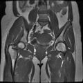 Abdominal wall endometriosis (Radiopaedia 83702-98847 Coronal T1 9).jpg