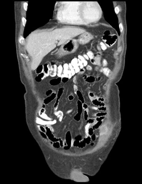 File:Abdominal wall metastasis from colorectal carcinoma (Radiopaedia 31016-31717 Coronal C+ portal venous phase 11).jpg