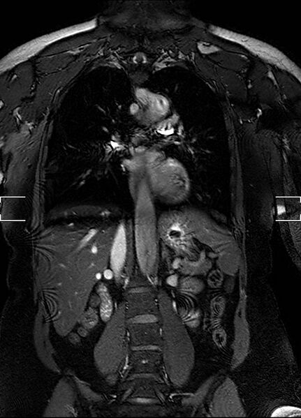 File:Aberrant right subclavian artery with background Takayasu arteritis (Radiopaedia 21423-21363 Coronal MRA 18).jpg